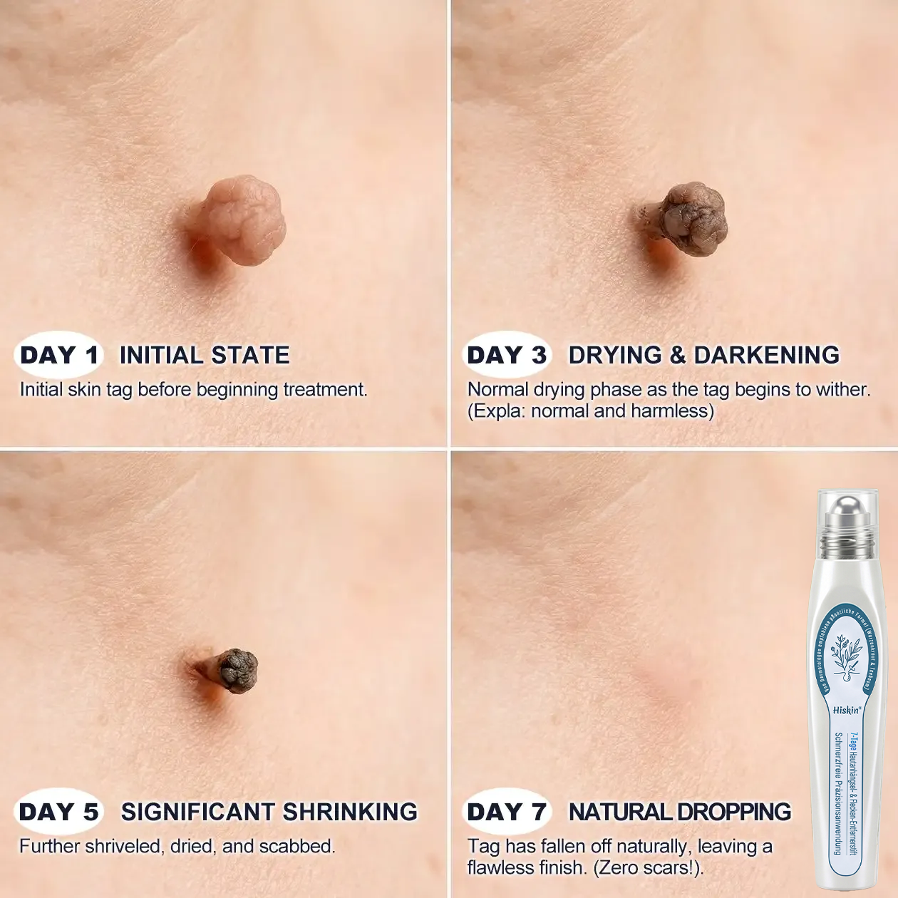 80%Off💥Hiskin ® 7-𝐷𝑎𝑦 𝗧𝐚𝐠 & 𝗦𝗽𝐨𝐭 𝐄𝐫𝒂𝒔𝒆𝒓(Zero Pain, Zero 𝐒𝐜𝐚𝒓𝒔 Rollerball)