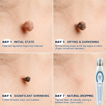 80%Off💥Hiskin ® 7-𝐷𝑎𝑦 𝗧𝐚𝐠 & 𝗦𝗽𝐨𝐭 𝐄𝐫𝒂𝒔𝒆𝒓(Zero Pain, Zero 𝐒𝐜𝐚𝒓𝒔 Rollerball)